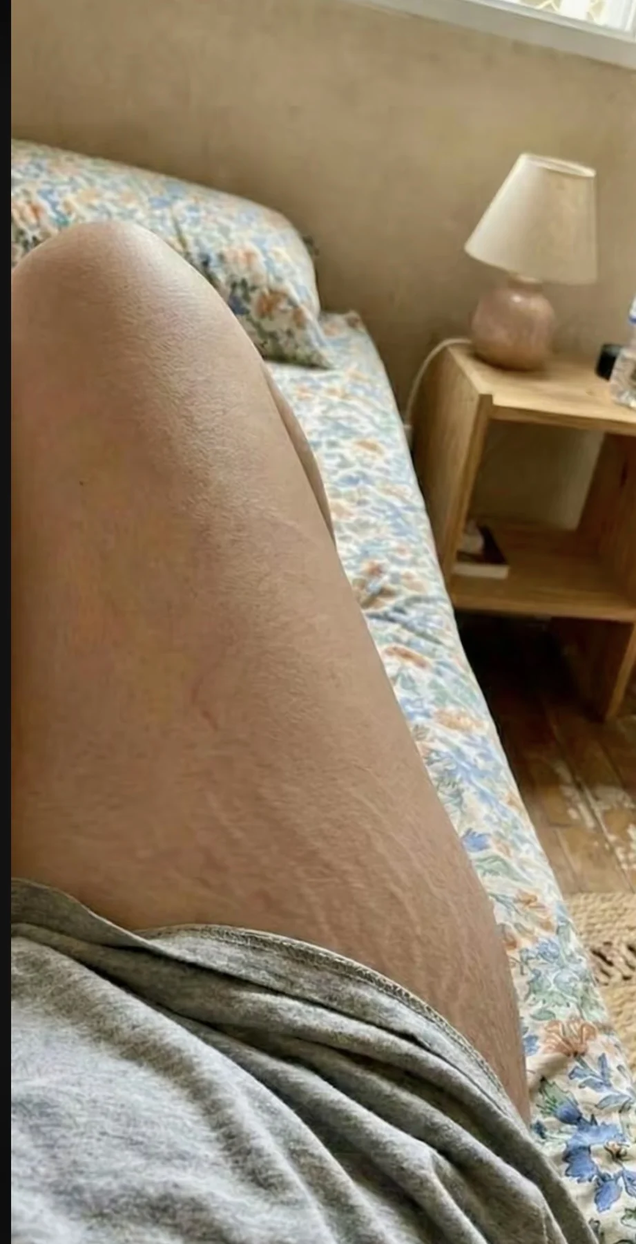 Depois do uso contínuo de SunBun — Textura e aparência da pele