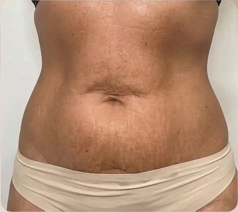 Depois do cuidado com SunBun: aparência da pele abdominal