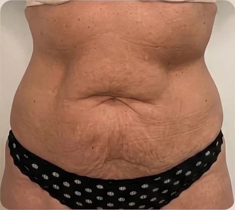 Antes do cuidado com SunBun: aparência da pele abdominal