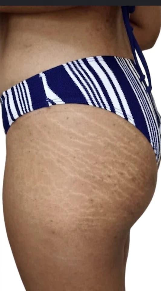 Antes do cuidado com SunBun: estrias aparentes no quadril